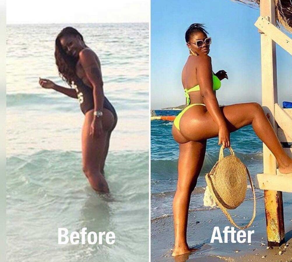 Salma Mumin before after butt enlargement 1